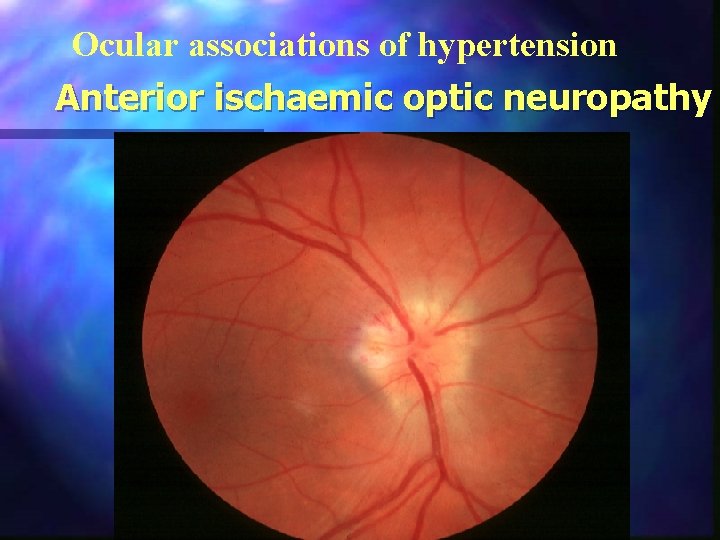 Ocular associations of hypertension Anterior ischaemic optic neuropathy 