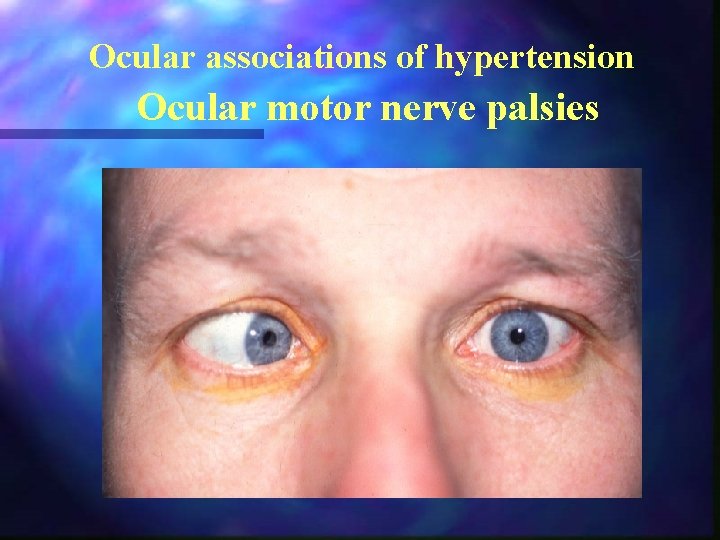 Ocular associations of hypertension Ocular motor nerve palsies 