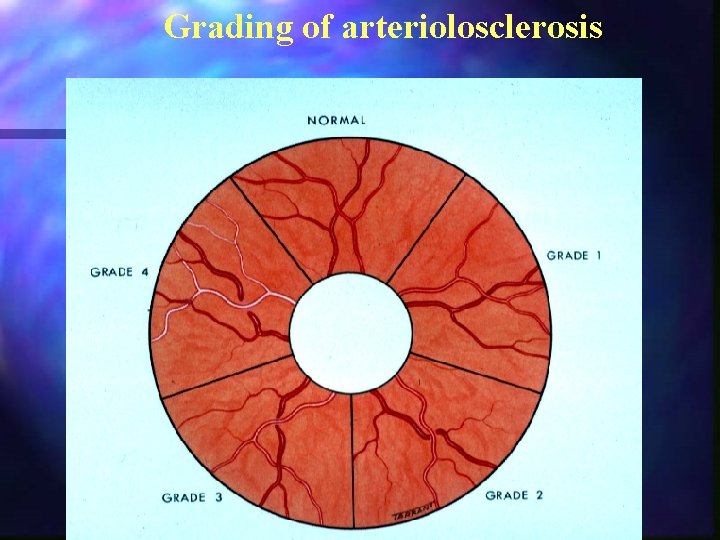 Grading of arteriolosclerosis 