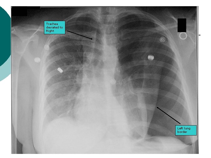 Trachea deviated to Right Left lung border 