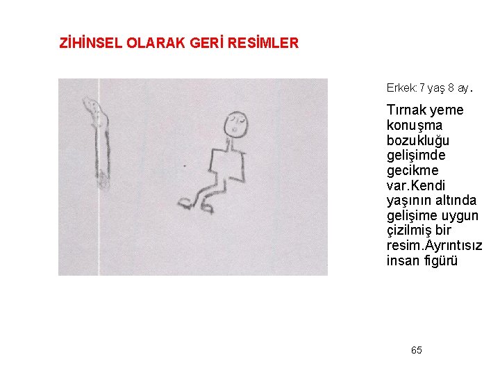 ZİHİNSEL OLARAK GERİ RESİMLER Erkek: 7 yaş 8 ay. Tırnak yeme konuşma bozukluğu gelişimde