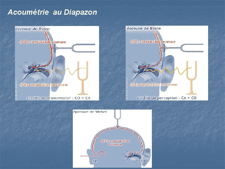 Acoumétrie au Diapazon 