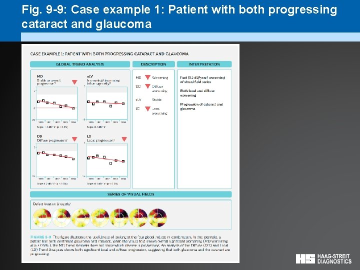 Fig. 9 -9: Case example 1: Patient with both progressing cataract and glaucoma 