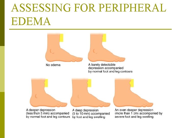 ASSESSING FOR PERIPHERAL EDEMA From Black, J. , Hawks, J, and Keene, A. (2001).