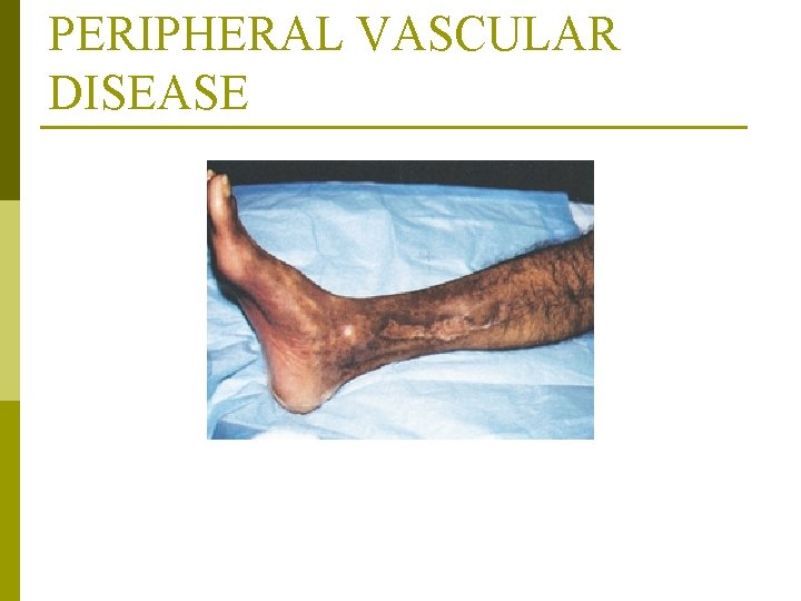 PERIPHERAL VASCULAR DISEASE From Bryant RA (1992): Acute and chronic wounds: nursing management, St.