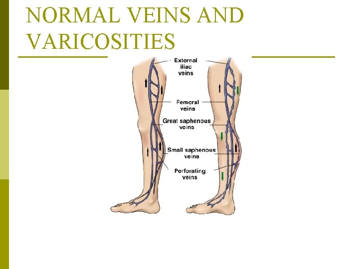 NORMAL VEINS AND VARICOSITIES From Monahan, F. & Neighbors, M. (1998). Medical-surgical nursing: Foundations