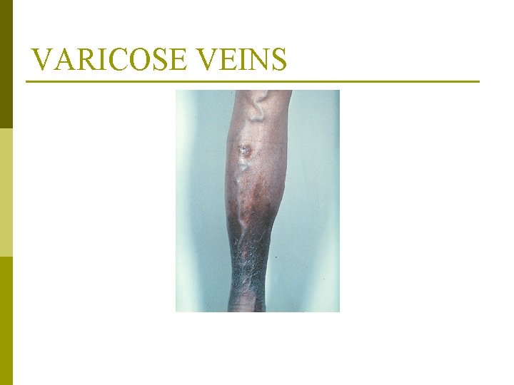 VARICOSE VEINS From Mosby’s Medical, Nursing, and Allied Health Dictionary, ed 6, (2002). St.