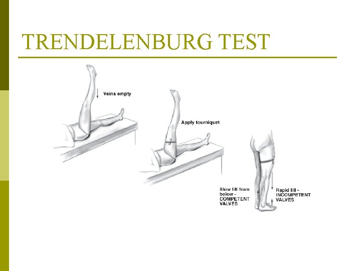 TRENDELENBURG TEST From Jarvis, C. (2000). Physical examination and health assessment, ed 3, Philadelphia: