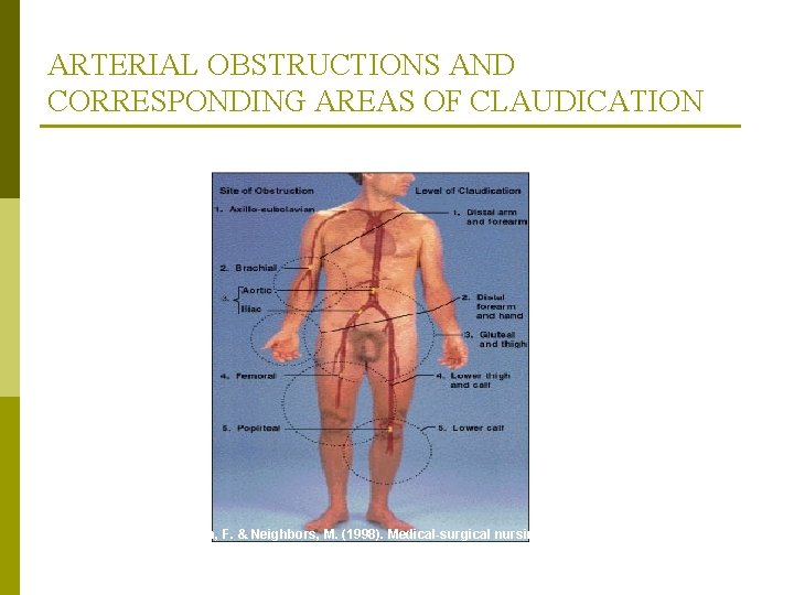 ARTERIAL OBSTRUCTIONS AND CORRESPONDING AREAS OF CLAUDICATION From Monahan, F. & Neighbors, M. (1998).