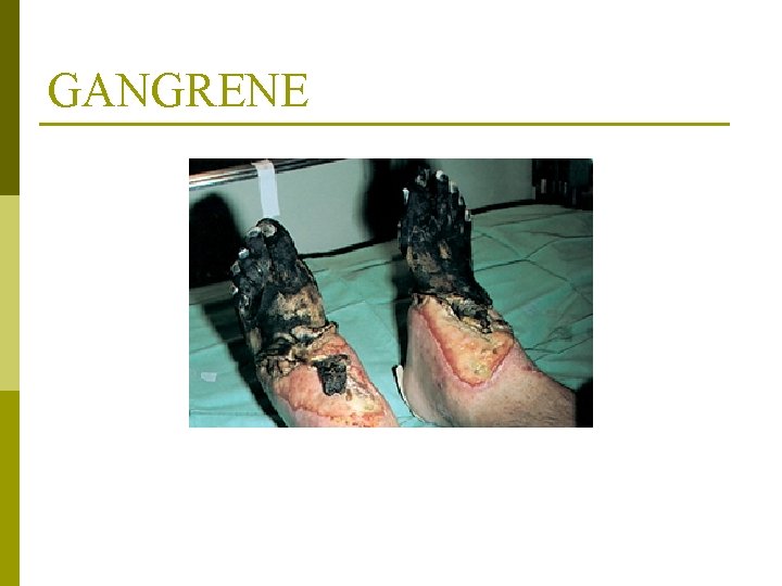 GANGRENE From Auerbach PS: Wilderness Medicine: Management of wilderness and environmental emergencies, ed. 3,