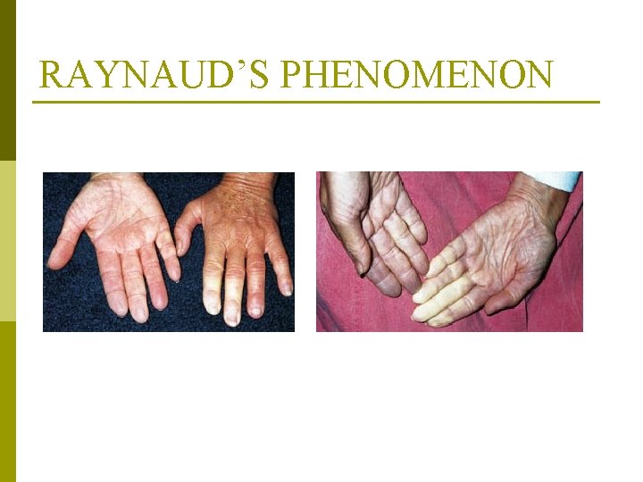 RAYNAUD’S PHENOMENON From Barkauskas VH et al (1998) Health and physical assessment (2 nd