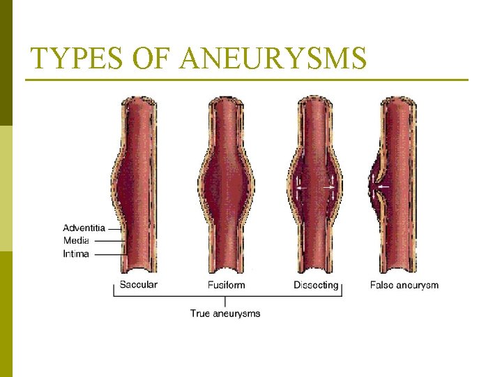 TYPES OF ANEURYSMS From Monahan, F. & Neighbors, M. (1998). Medical-surgical nursing: Foundations for