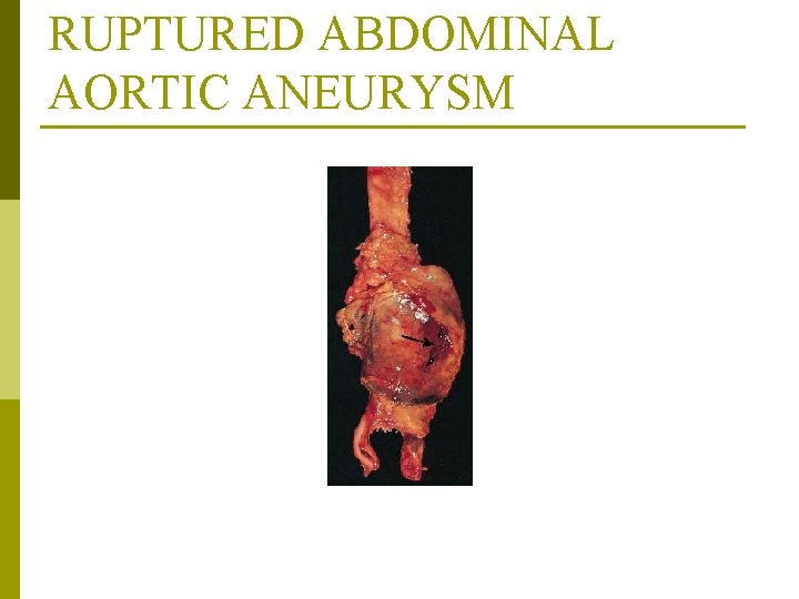 RUPTURED ABDOMINAL AORTIC ANEURYSM From Cotran RS, Kumar V, Collins T: Robbins’ pathologic basis