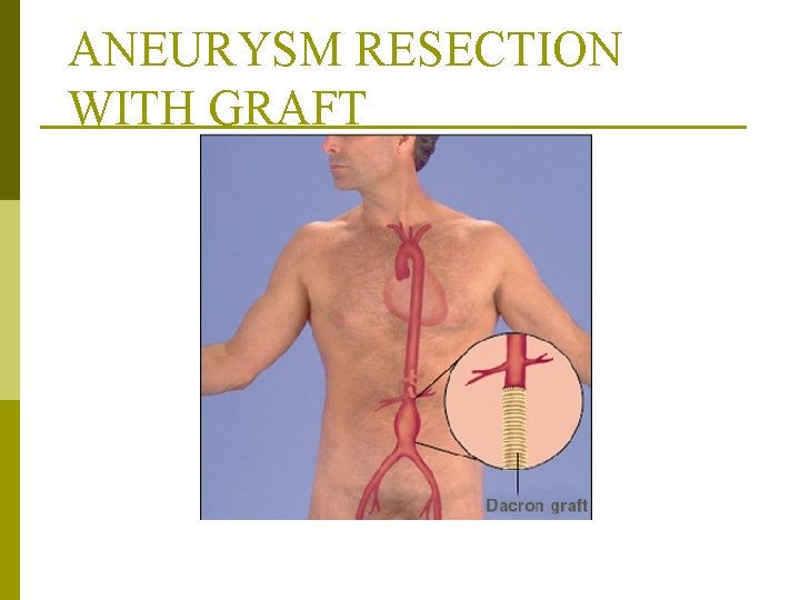 ANEURYSM RESECTION WITH GRAFT From Monahan, F. & Neighbors, M. (1998). Medical-surgical nursing: Foundations