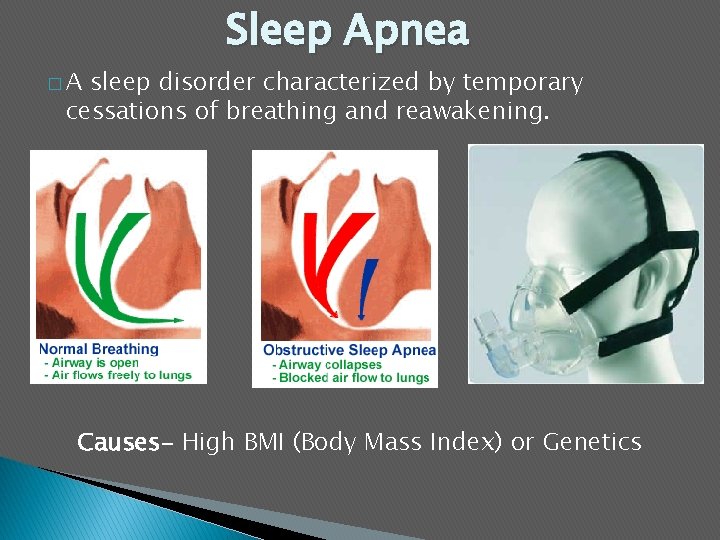 Sleep Apnea �A sleep disorder characterized by temporary cessations of breathing and reawakening. Causes-