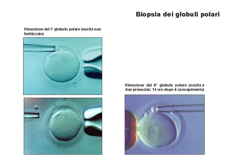 Biopsia dei globuli polari Rimozione del I° globulo polare (oocita non fertilizzato) Rimozione del