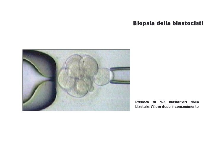 Biopsia della blastocisti Prelievo di 1 -2 blastomeri dalla blastula, 72 ore dopo il