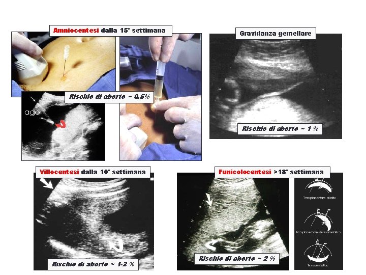 Amniocentesi dalla 15° settimana Gravidanza gemellare Rischio di aborto ~ 0. 5% Rischio di