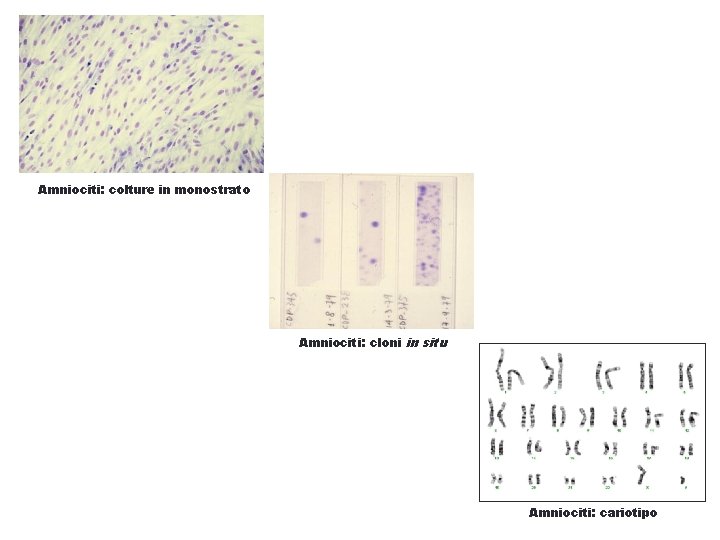 Amniociti: colture in monostrato Amniociti: cloni in situ Amniociti: cariotipo 