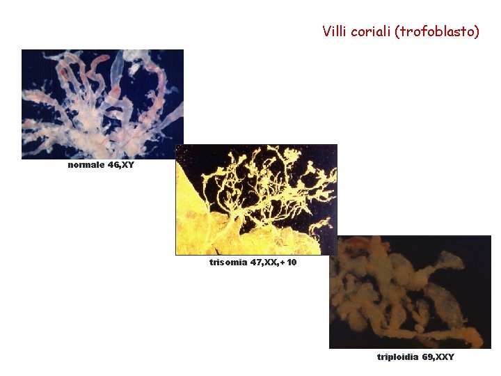 Villi coriali (trofoblasto) normale 46, XY trisomia 47, XX, +10 triploidia 69, XXY 