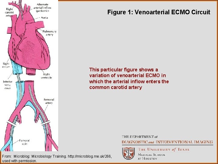 Figure 1: Venoarterial ECMO Circuit This particular figure shows a variation of venoarterial ECMO