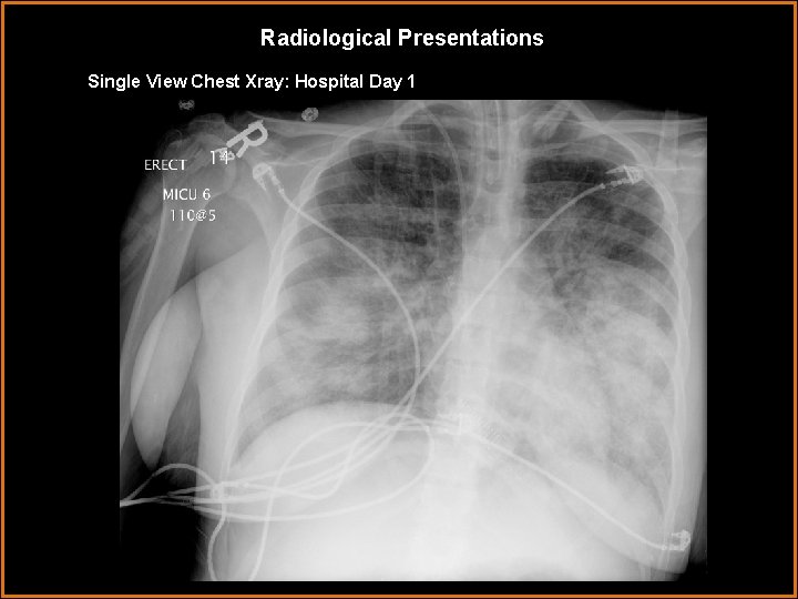 Radiological Presentations Single View Chest Xray: Hospital Day 1 