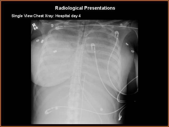 Radiological Presentations Single View Chest Xray: Hospital day 4 Radiological Presentations Single View Chest Xray: Hospital day 4