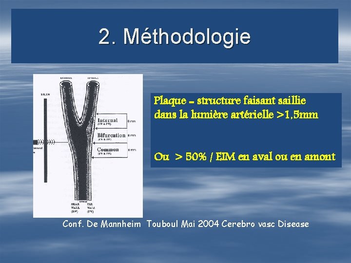 2. Méthodologie Plaque = structure faisant saillie dans la lumière artérielle >1, 5 mm
