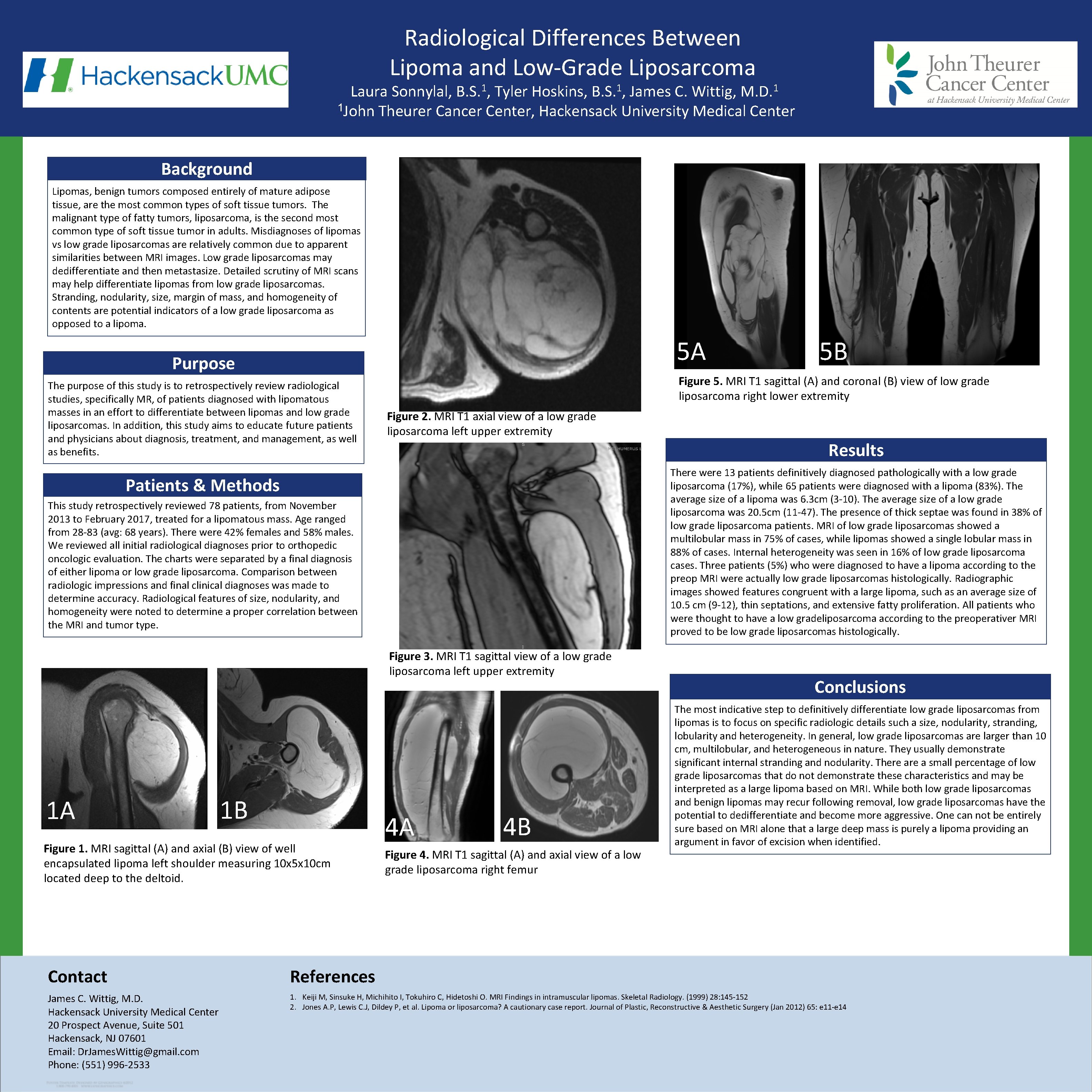 Radiological Differences Between Lipoma and Low-Grade Liposarcoma Laura Sonnylal, B. S. 1, Tyler Hoskins,