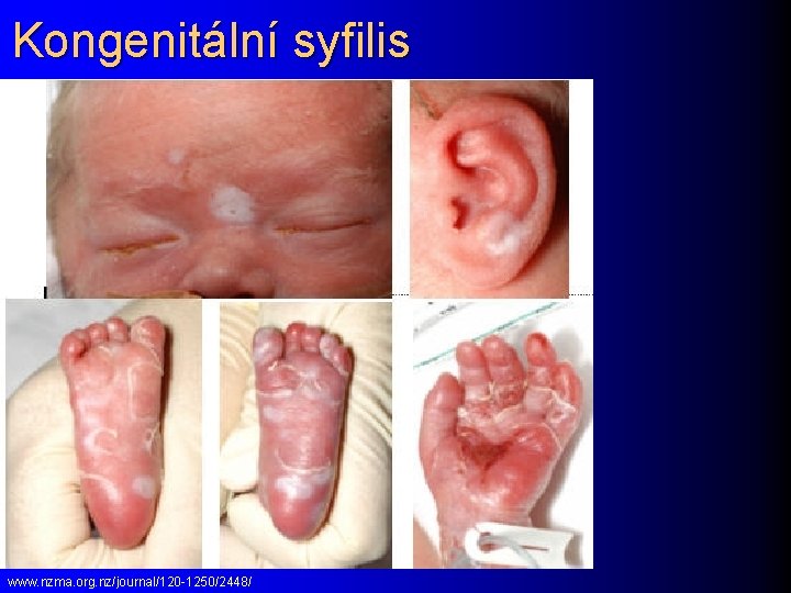 Kongenitální syfilis www. nzma. org. nz/journal/120 -1250/2448/ 