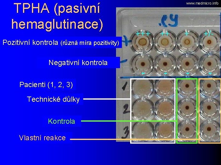 TPHA (pasivní hemaglutinace) Pozitivní kontrola (různá míra pozitivity) www. medmicro. info +++ ++ +