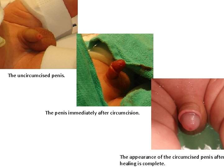 The uncircumcised penis. The penis immediately after circumcision. The appearance of the circumcised penis