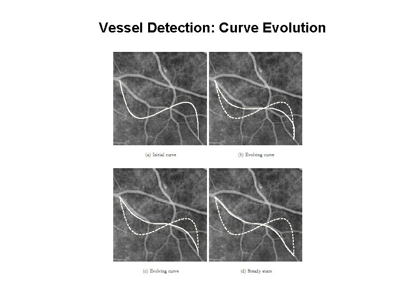 Vessel Detection: Curve Evolution 