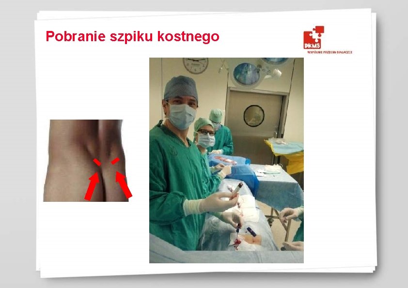 Pobranie szpiku kostnego 