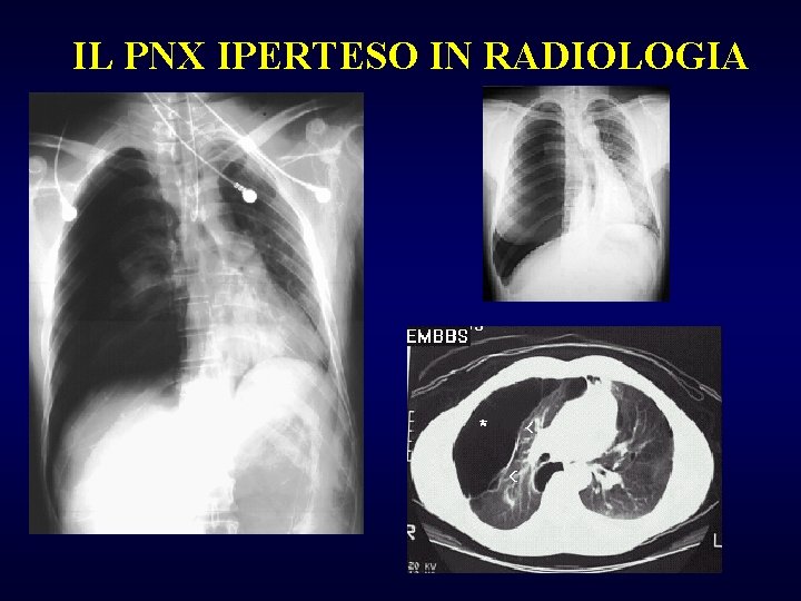 IL PNX IPERTESO IN RADIOLOGIA 