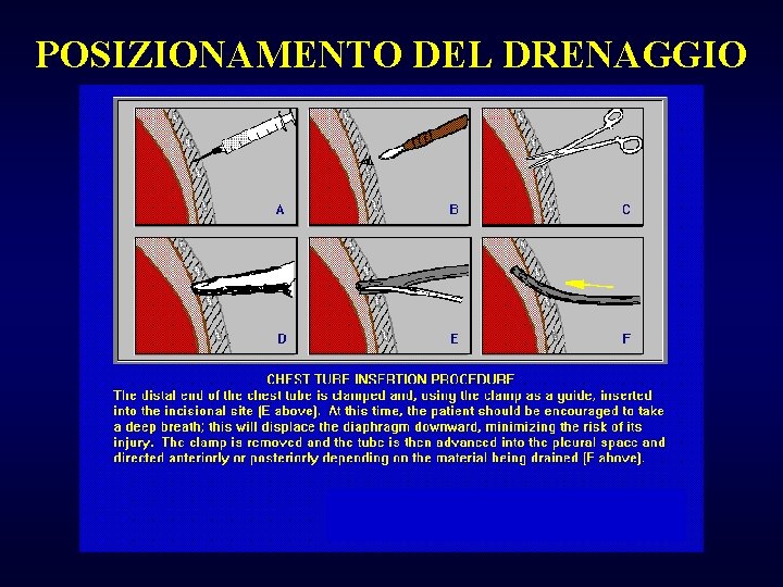 POSIZIONAMENTO DEL DRENAGGIO 