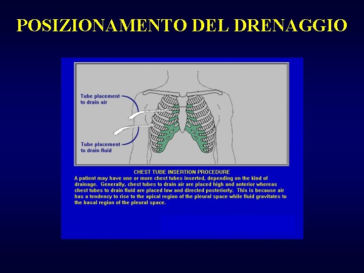 POSIZIONAMENTO DEL DRENAGGIO 