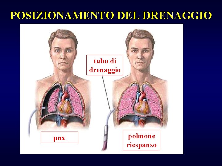 POSIZIONAMENTO DEL DRENAGGIO tubo di drenaggio pnx polmone riespanso 