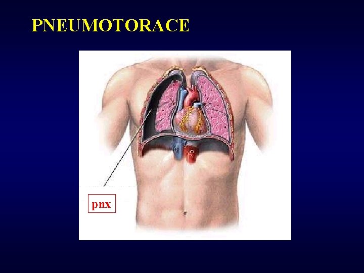 PNEUMOTORACE pnx 