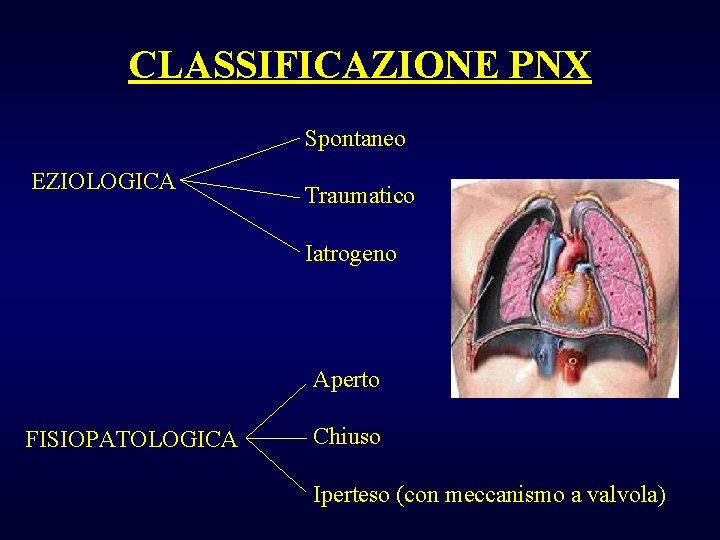 CLASSIFICAZIONE PNX Spontaneo EZIOLOGICA Traumatico Iatrogeno Aperto FISIOPATOLOGICA Chiuso Iperteso (con meccanismo a valvola)