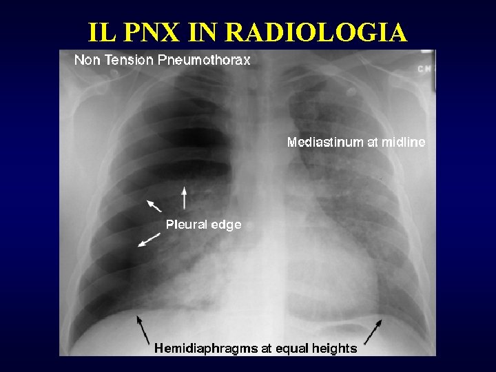 IL PNX IN RADIOLOGIA 