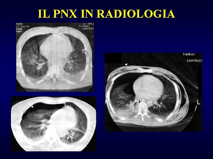 IL PNX IN RADIOLOGIA 