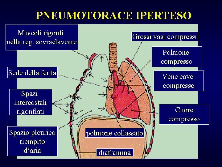 PNEUMOTORACE IPERTESO Muscoli rigonfi nella reg. sovraclaveare Grossi vasi compressi Polmone compresso Sede della