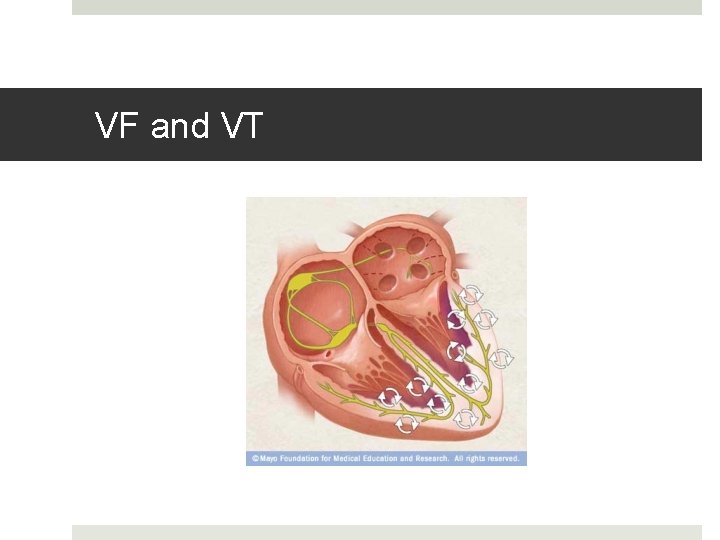 VF and VT 