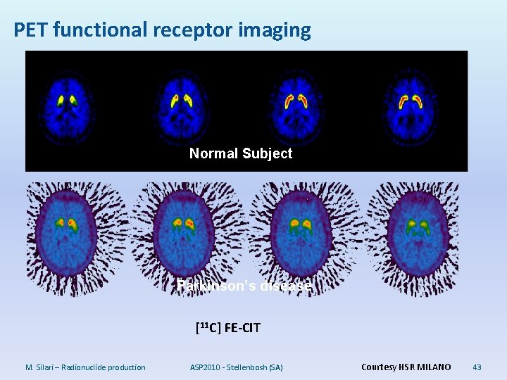 PET functional receptor imaging Normal Subject Parkinson’s disease [11 C] FE-CIT M. Silari –