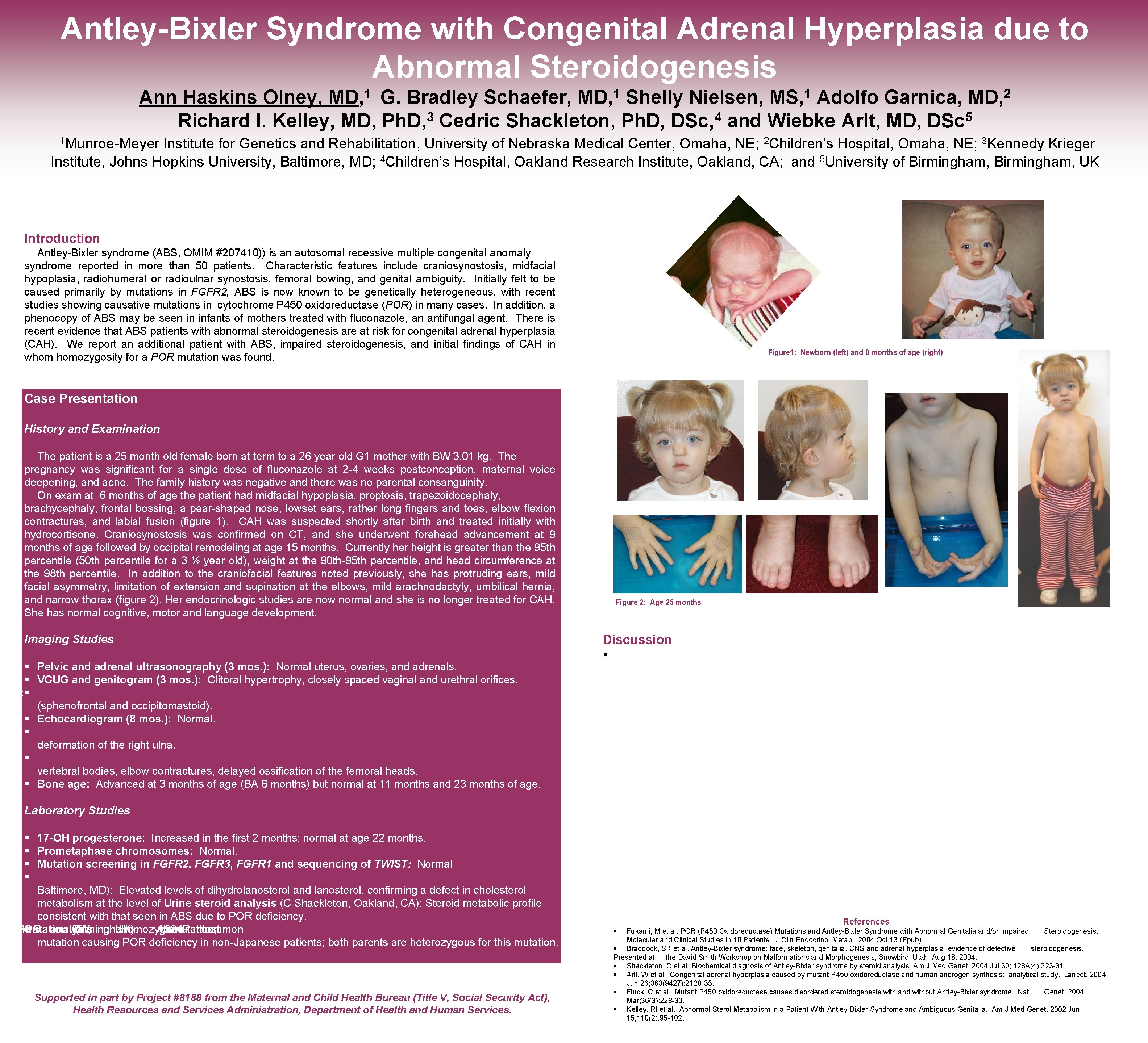 Antley-Bixler Syndrome with Congenital Adrenal Hyperplasia due to Abnormal Steroidogenesis 1 MD, 1 MS,