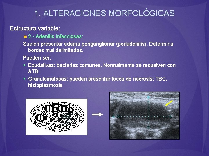 1. ALTERACIONES MORFOLÓGICAS Estructura variable: 2. - Adenitis infecciosas: Suelen presentar edema periganglionar (periadenitis).