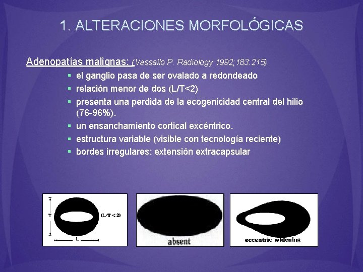 1. ALTERACIONES MORFOLÓGICAS Adenopatías malignas: (Vassallo P. Radiology 1992; 183: 215). § el ganglio