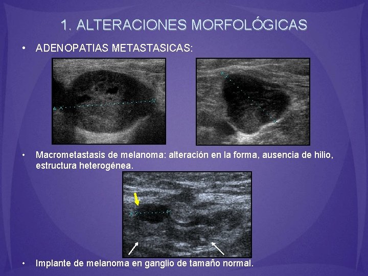 1. ALTERACIONES MORFOLÓGICAS • ADENOPATIAS METASTASICAS: • Macrometastasis de melanoma: alteración en la forma,