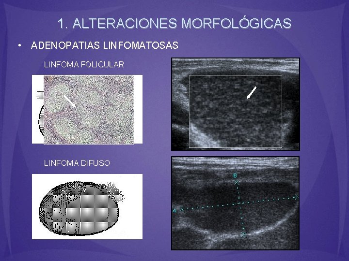 1. ALTERACIONES MORFOLÓGICAS • ADENOPATIAS LINFOMATOSAS LINFOMA FOLICULAR LINFOMA DIFUSO 